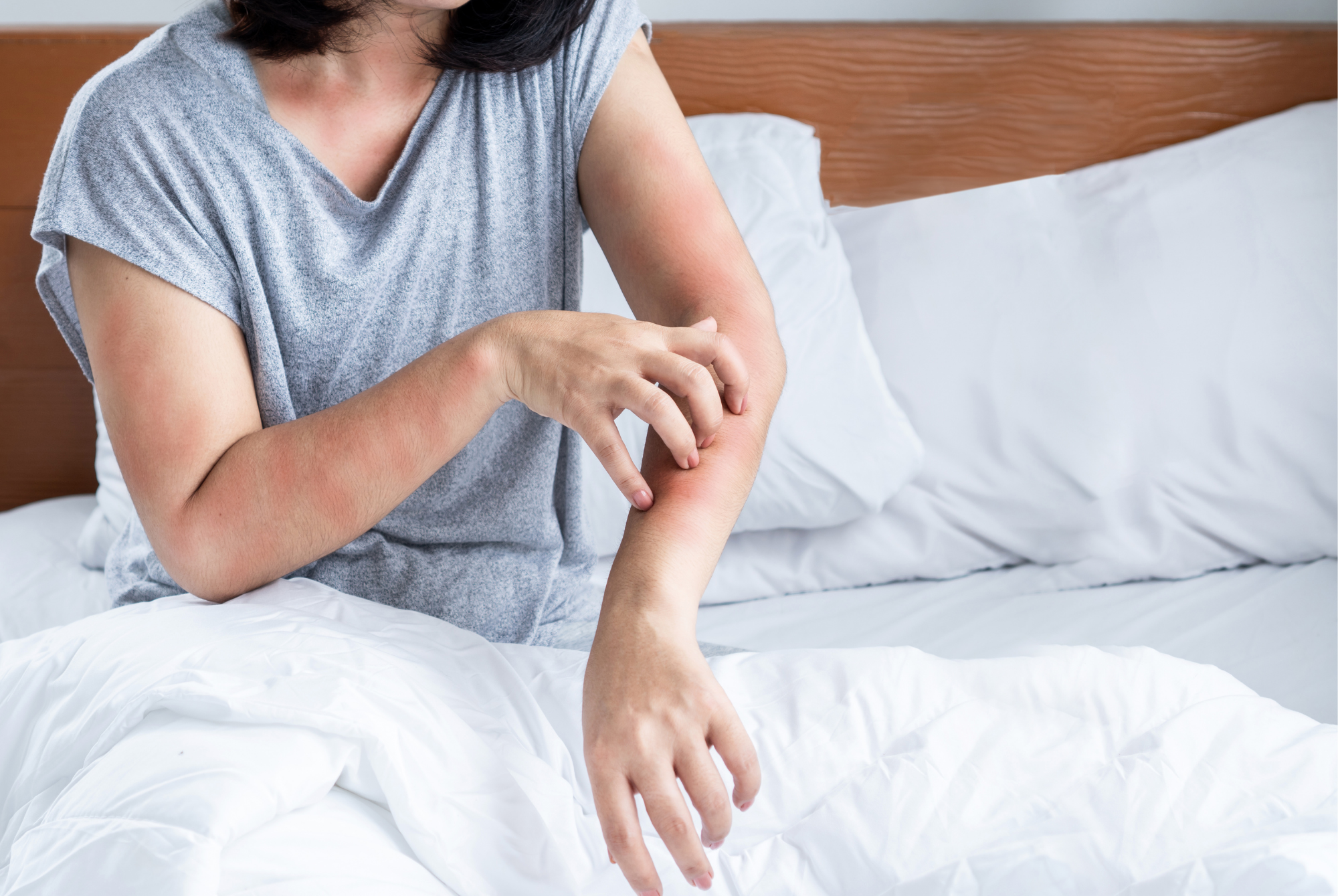 Woman sitting on a white bed scratching an irritated red patch on her forearm